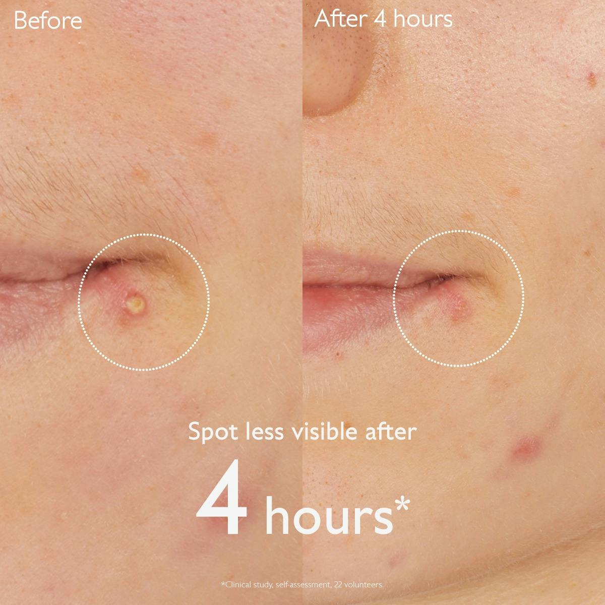 Salicylic Spot Solution 15ml