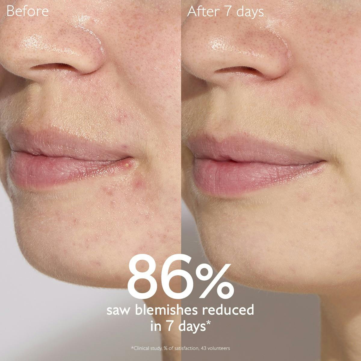 Blemish Control Infusion Serum 30ml